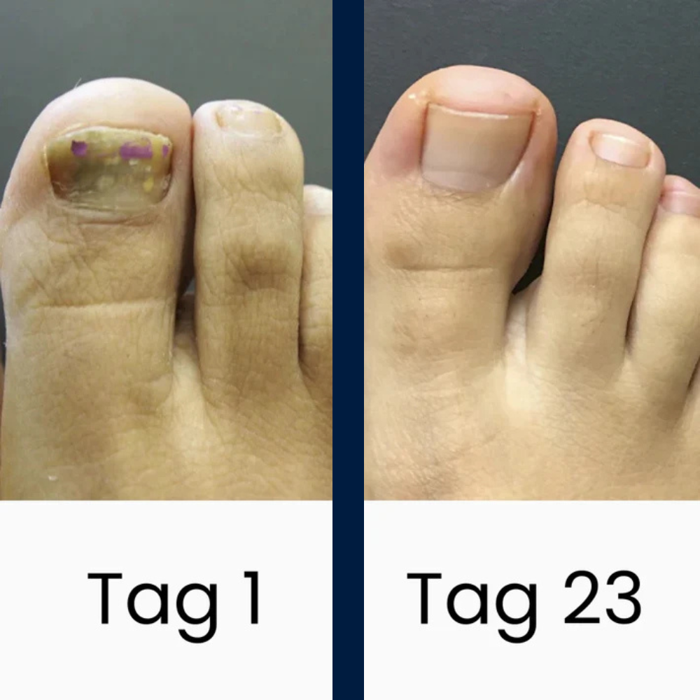 DermaBlue® UV-Blaulicht Therapiegerät gegen Nagelpilz