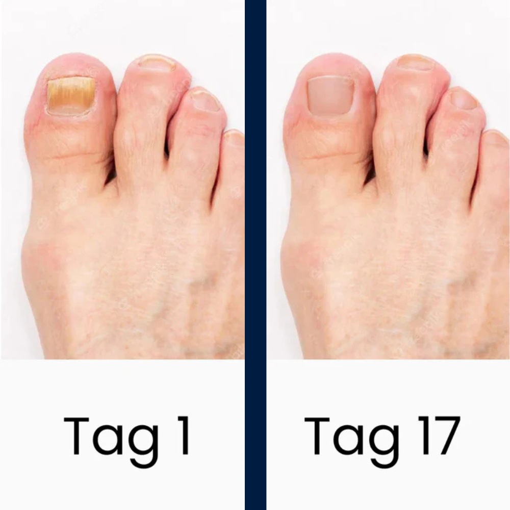 DermaBlue® UV-Blaulicht Therapiegerät gegen Nagelpilz