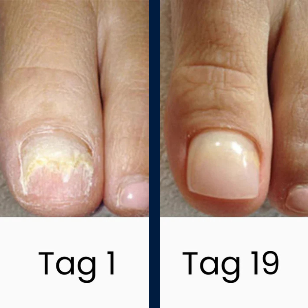 DermaBlue® UV-Blaulicht Therapiegerät gegen Nagelpilz
